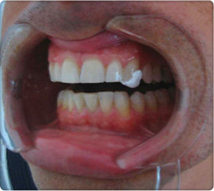 Tooth Fractures